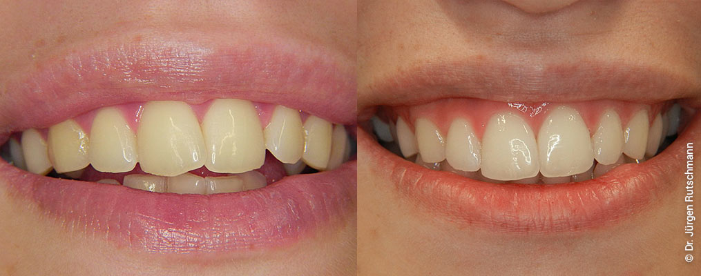 invisalign-1 Invisalign Basel