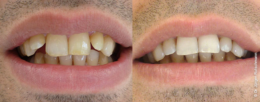 invisalign-2 Invisalign Basel