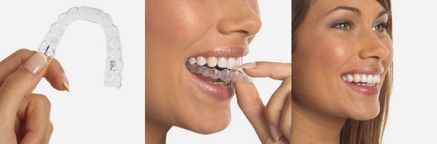 invisalign-basel Invisalign Basel