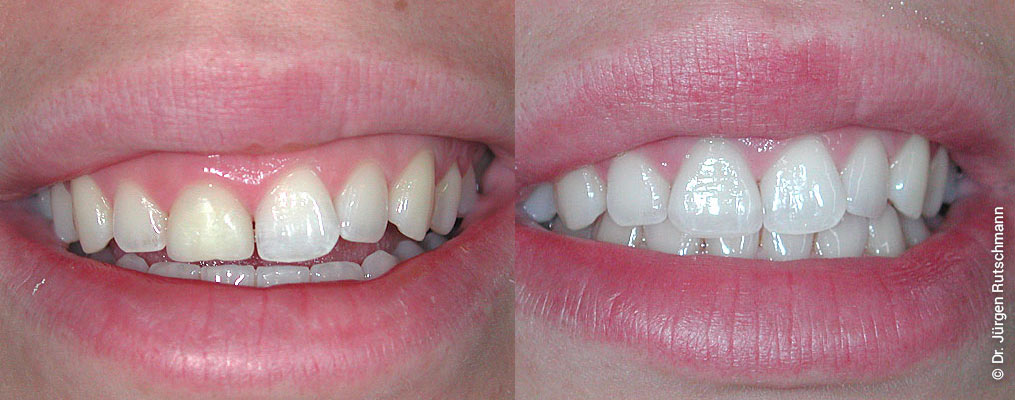 veneers-2 Veneers Zahnarzt Basel
