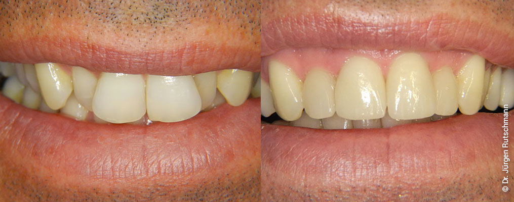 veneers-3 Veneers Zahnarzt Basel