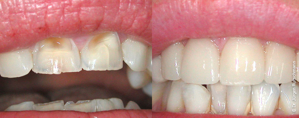 veneers Veneers Basel