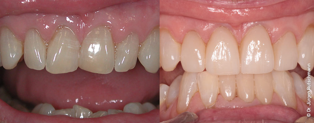 veneers-vorher-nachher-1